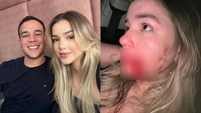 Modelo leva soco de síndico e fica com buraco no rosto