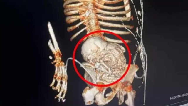 Família autoriza estudo de bebê calcificado por mais de 50 anos no ventre
