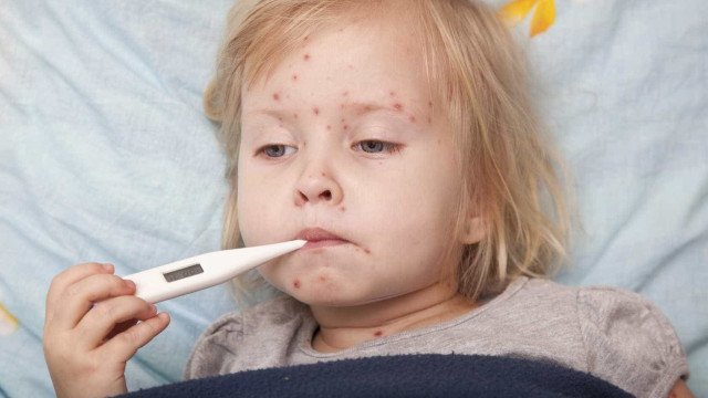 São Paulo fica sem vacina para a 2ª dose contra a catapora