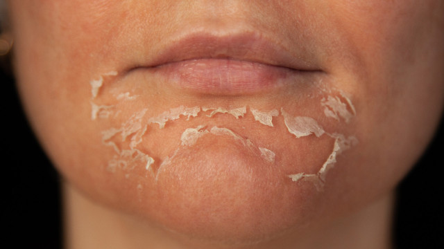 Mulher sofre queimaduras graves após peeling de fenol no PR