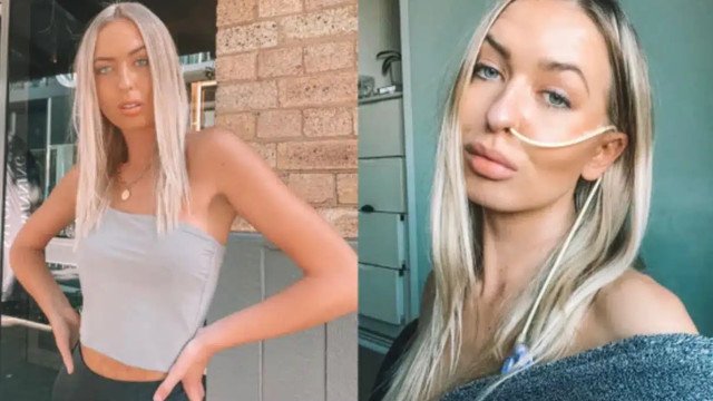 Vacterl: Anomalia fez modelo nascer com duas vaginas