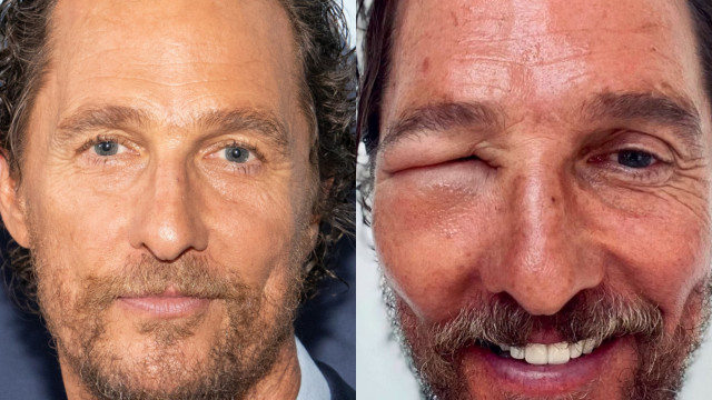 Matthew McConaughey preocupa fãs ao surgir com olho (muito) inchado