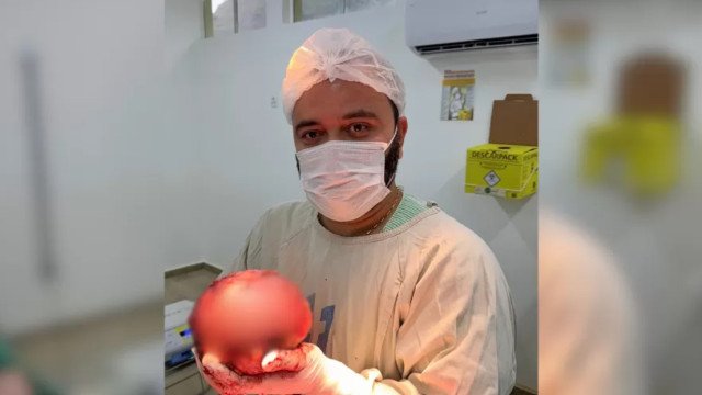 Médico mostra extração de tumor gigante de quase 2 kg: ‘Um recorde’
