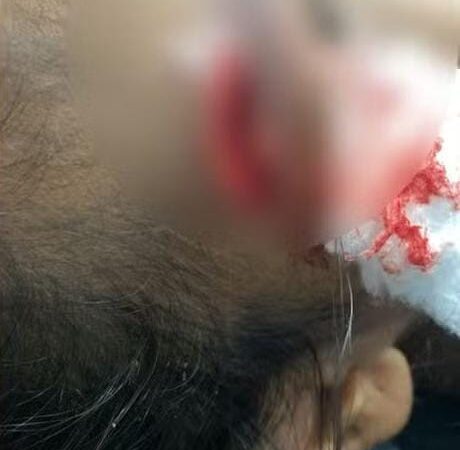 Mãe é presa por agressão à filha de 3 anos com cabo de vassoura em Várzea Grande