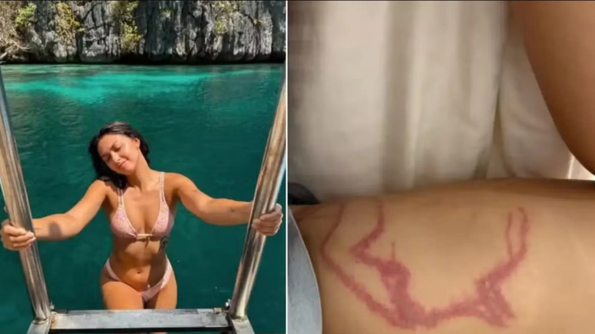 Influencer é picada por espécie de água-viva “mais venenosa” do mundo