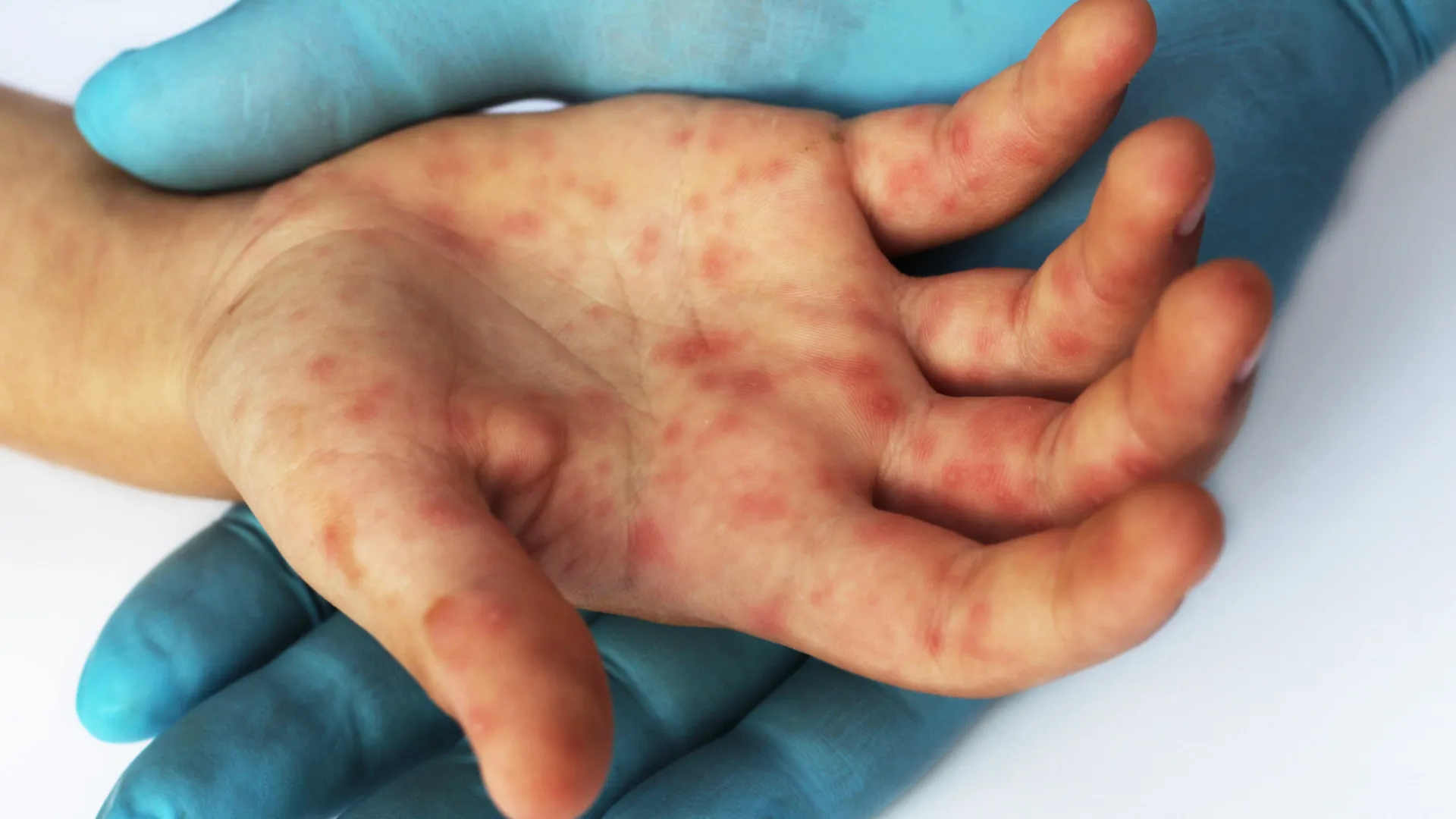 Tocantins registra surto de sarampo com seis casos confirmados da doença