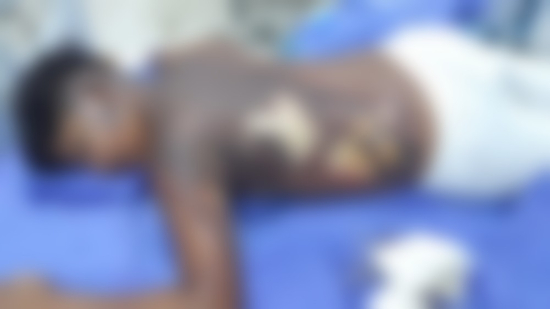 Polícia investiga queimaduras suspeitas em adolescente de 13 anos em Sorriso