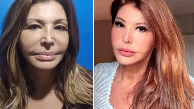 Lembra dela? Musa dos anos 90 recorre à harmonização facial