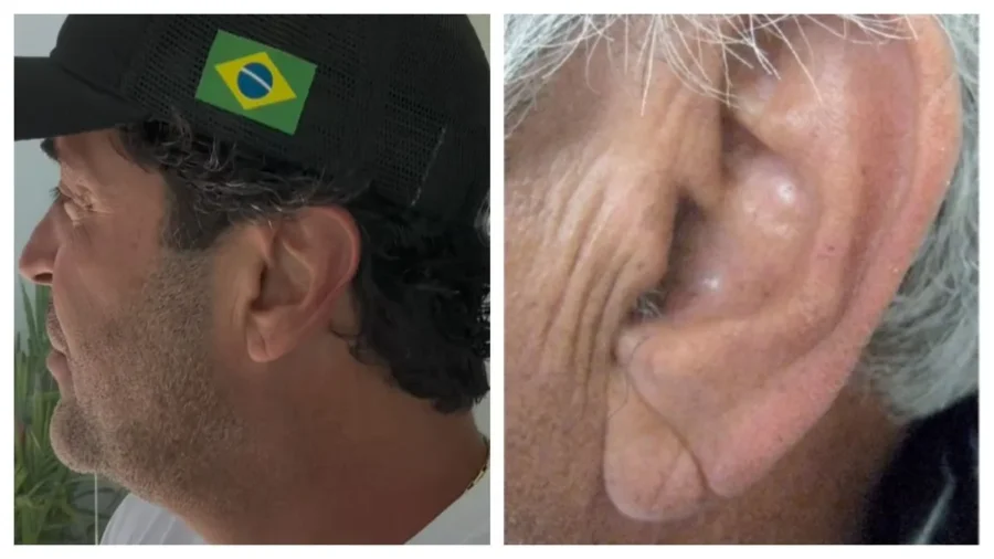 Sinal de Frank: mito ou marcador de risco cardiovascular? Entenda