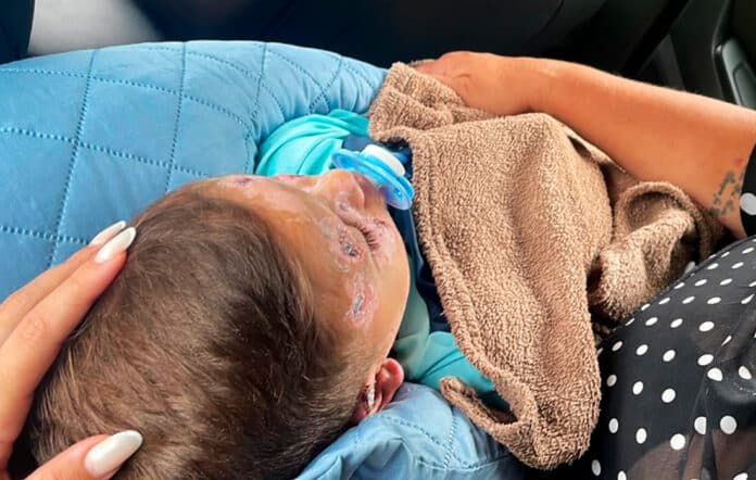 Enrico, de 3 anos, recebe alta médica após queimaduras e continua tratamento em Sinop