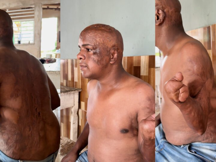 Jovem que perdeu braço e pé após queimaduras teme perder benefício do INSS após chegar 10 minutos atrasado à perícia