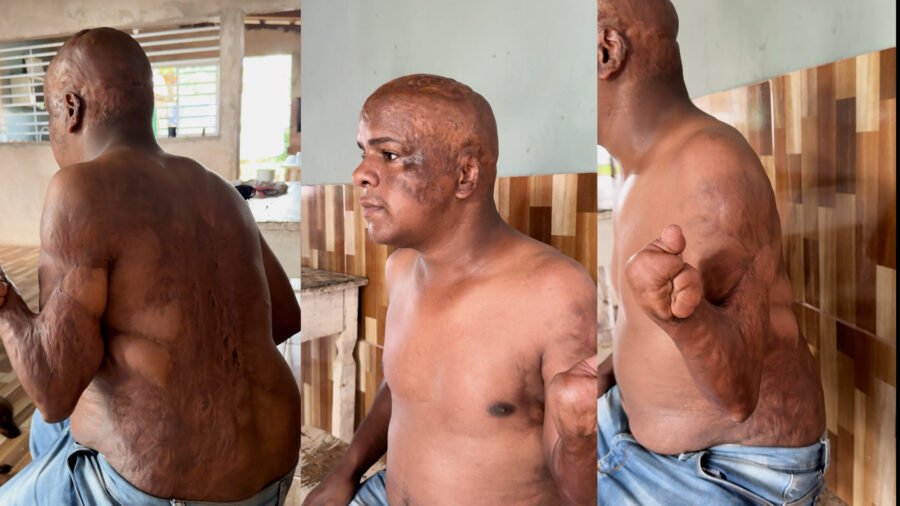 Jovem que perdeu braço e pé após queimaduras teme perder benefício do INSS após chegar 10 minutos atrasado à perícia