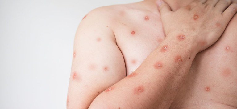 Cuiabá emite alerta para mpox mesmo sem casos confirmados; entenda o motivo