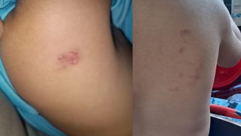 Mãe denuncia professora após criança de 2 anos aparecer com hematomas em creche de Sinop