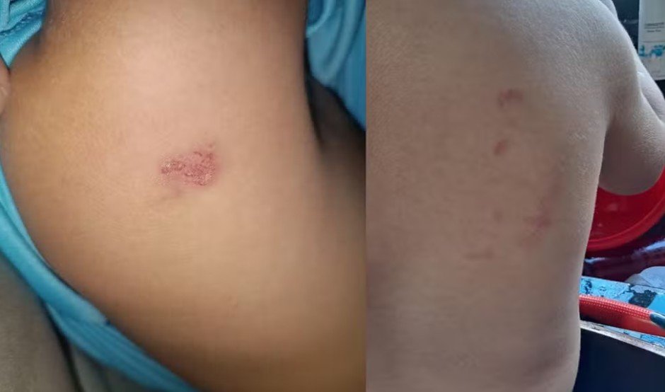 Mãe denuncia professora após criança de 2 anos aparecer com hematomas em creche de Sinop
