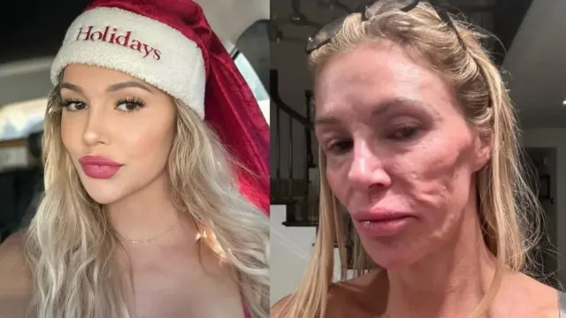 Ex-modelo que teve rosto ‘derretido’ revela origem da doença