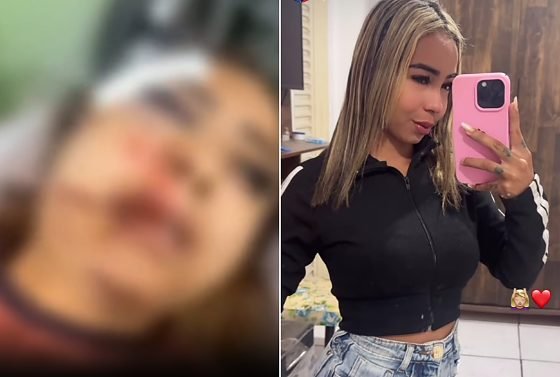 Garota de programa espancada por cliente em MT teve a mandíbula quebrada e família pede ajuda