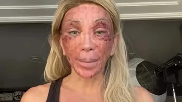 ‘Não consigo nem rir’, diz Maya Massafera mostra rosto inchado após peeling e ironiza reação: ‘Não consigo nem rir’
