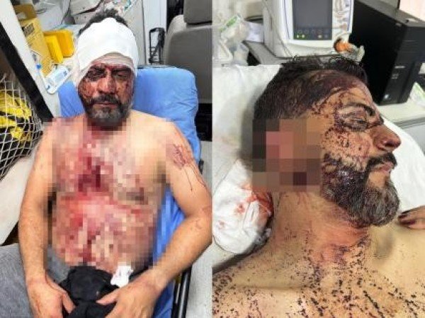 Bandidos queriam R$ 1 milhão, cortam orelha de vereador e ameaçam cortar braço do filho